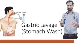 GASTRIC LAVAGE STOMACH WASH STOMACH IRRIGATION ICU PROCEDURE DR SALMAN NASIR [upl. by Maxa564]