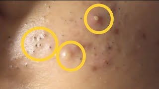 Blackheads and Epidermoid Cyst Part 2 [upl. by Anile733]