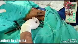 PNS GUIDED POPLITEAL SCIATIC NERVE BLOCK INTER TENDINOUS APPROACH [upl. by Uria]