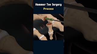 Hammer Toe Surgery Understanding the Procedure surgeryanimation [upl. by Ilise]