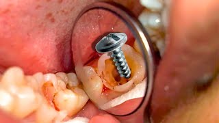 4K 😱 LOOK AT HIS TEETH ☠️ TREATMENT OF A REDUCED TOOTH WITH CARIES [upl. by Eecrad]