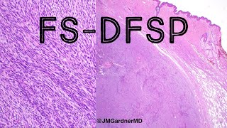 FSDFSP fibrosarcomatous dermatofibrosarcoma protuberans pathology dermpath dermatology [upl. by Aynas]