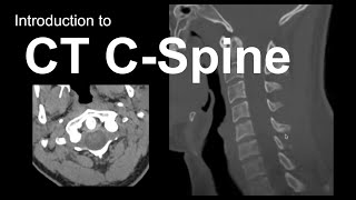 How to Read a CT of the Lumbar Spine A Beginners Approach [upl. by Glogau254]