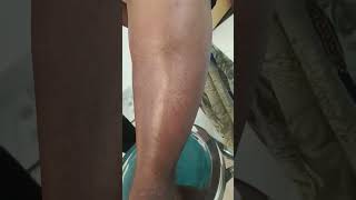 quotConsequences of Untreated Leg Cellulitis A Warning Videoquot [upl. by Akired]