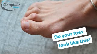 Healthy Feet what to do for hammer toe [upl. by Leirea121]