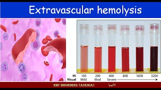 Lecture 213 Extravascular hemolysis [upl. by Mannuela]