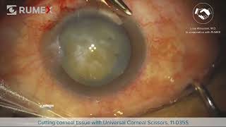 Surgery Live Cutting Corneal Tissue [upl. by Llenrahs909]