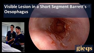 Visible Lesion in a Short Segment Barretts Oesophagus [upl. by Elakram805]