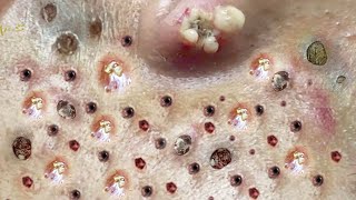 Blackhead Removal With Sac Dep Spa 100074051 [upl. by Na663]