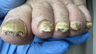 Treatment of thick yellow nails with a fungal infection Blood vessels have grown into the nail [upl. by Brendin]