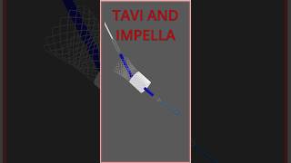 IMPELLA AND TAVI INTERACTION impella [upl. by Nitsrik]