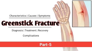 Greenstick Fracture  PART5  Explained in Hindi [upl. by Sikes]