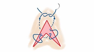 Suturing a V shaped wound filmed through GoogleGlass [upl. by Ilaire66]