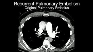 Recurrent Pulmonary Embolism [upl. by Raven]