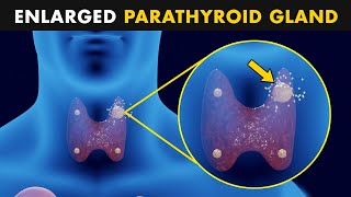 Hyperparathyroidism  Symptoms Causes And Treatment [upl. by Aryam228]