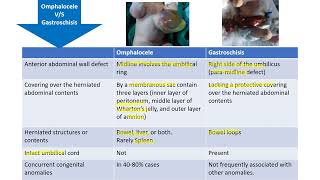 Omphalocele vs Gastroschisis  Spot Diagnosis  6  Pediatrics [upl. by Adiol]