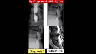 Diagnosis   Lumber Myelogram amp MRI Spine  Practical case [upl. by Einaeg467]