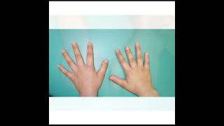 Brachydactyly Treatment  Symptoms and Causes  Diagnosis  Prevention health [upl. by Lletnuahs]