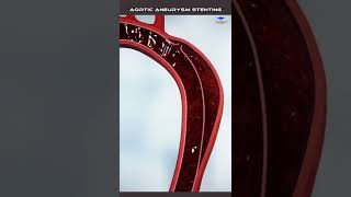 Aortic Dissection stenting medical video [upl. by Slerahc198]