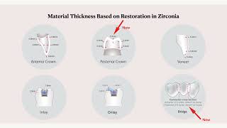 Zirconia 101 3 of 11 Preparation Indications for zirconia [upl. by Gavan]