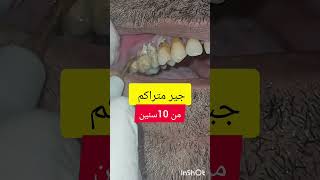 ازالة وتنظيف جير و تقليح الاسنان dentist stitch اكسبلور stitchlover ترند [upl. by Cora569]