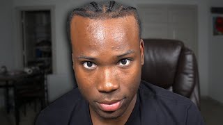 Is My Hairline Cooked [upl. by Leff]