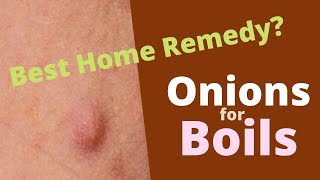 Onions for Boils Excellent Natural Remedy for Skin Abscess [upl. by Nnylamme]