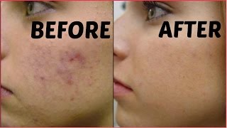 How To Remove Dark Spots Acne Scars Black Spots In Just 3 Days  Get Flawless Glowing Skin [upl. by Nylhtac]