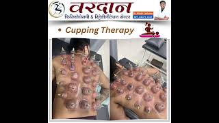 Cupping therapy backpaintreatment neckpaintreatment bestphysiotherapy surat trending [upl. by Hedwiga505]