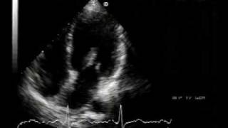 echocardiogram  chordal rupture 22 [upl. by Katherina]