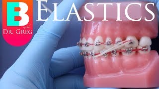 BRACES EXPLAINED Elastics  Rubber Bands [upl. by Holleran]