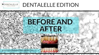 Before and After a Teeth Cleaning  Dentalelle Edition [upl. by Nirihs859]