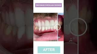 What Do Dental Crowns Look Like​ See Yourself  Longevita [upl. by Aneekas]