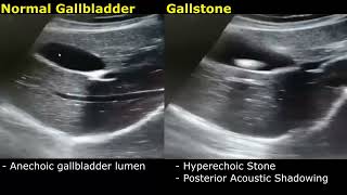 Gallstone Ultrasound RealTime Scan Normal Vs Abnormal Appearance  Cholelithiasis  Gallbladder USG [upl. by Light533]