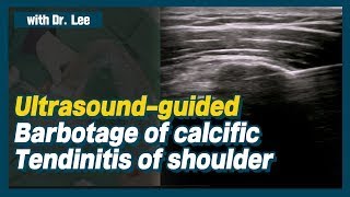 TrailerUltrasoundguided lavage of calcific tendinitis of shoulder ruptured calcification [upl. by Ribak214]