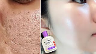 How to use Lacto Calamine Lotion  Lacto Calamine Lotion For Clear Spotless Brighten Skin [upl. by Thorne986]