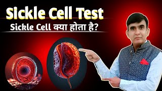 Sickle Cell Test Procedure  Blood Test  pathology Practical [upl. by Mir]