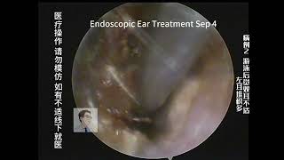 Ear wax removal of children’s ear 20230904 [upl. by Tailor]