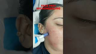 mesotherapy prp skincare beauty aesthetician faceoffclinic khanaesthetics aesthetics [upl. by Nalahs306]