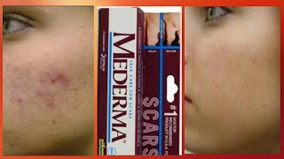 Mederma skin cream review  Scar ointment gel Mederma [upl. by Scholz]