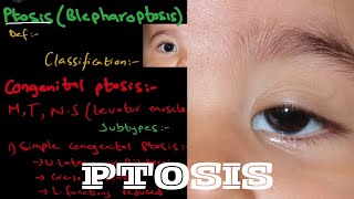 What is Ptosis  Droopy eyelid   it’s types and treatment  detailed explanation [upl. by Eissoj258]