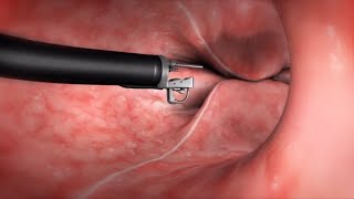 What Happens During the Endoscopic Sleeve Gastroplasty ESG Procedure [upl. by Fionna692]