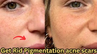 Get rid of pigmentation dark spots scars amp pimplesGet Rid Dark amp Dry skinaliyanalizafamily [upl. by Liamsi350]