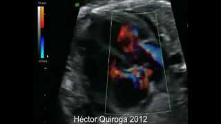 Taquicardia supraventricular fetal antes y después del tratamiento [upl. by Entwistle]