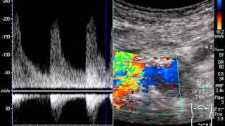 renal artery stenosis [upl. by Arahsak839]