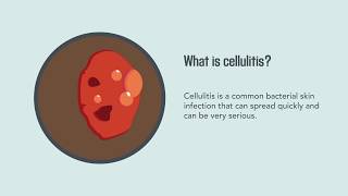 Cellulitis Causes Symptoms Diagnosis and Treatment  Merck Manual Consumer Version Quick Facts [upl. by Martinsen]