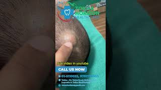 Scalp  cyst  removal  tokha horizon  lipoma cyst clinic nepal [upl. by Ahsenal]