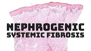 Nephrogenic systemic fibrosis from Gadolinium MRI contrast pathology dermatology dermatopathology [upl. by Heeley]