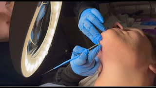 165 Hours of Electrolysis  Permanent Facial Hair Removal TimeLapse  PCOS Hirsutism [upl. by Cate]