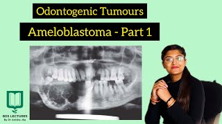 Ameloblastoma  Odontogenic Tumours  Lecture 19  Oral Pathology [upl. by Norton]